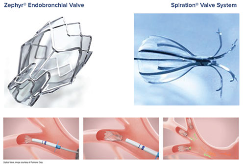 Zephyr® Endobronchial Valve and the Spiration® Valve System